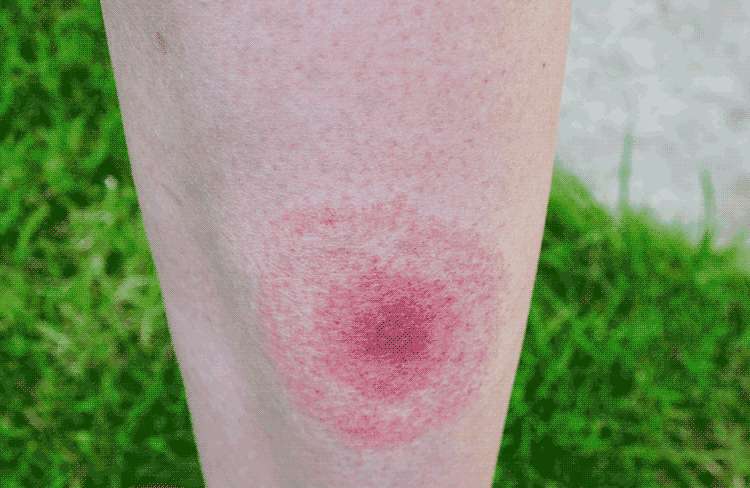 Red tick bite on skin.